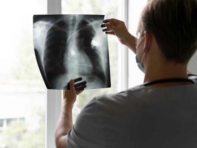 Presentan nueva herramienta para el diagnóstico de cáncer de pulmón