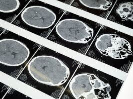 No es solo cuestión de cumplir años: la mala salud metabólica envejece tu cerebro por una vía completamente independiente