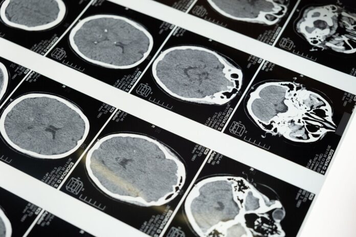 No es solo cuestión de cumplir años: la mala salud metabólica envejece tu cerebro por una vía completamente independiente