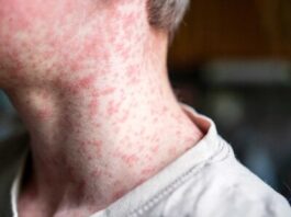 Muerte por sarampión en Pensilvania en medio de epidemia